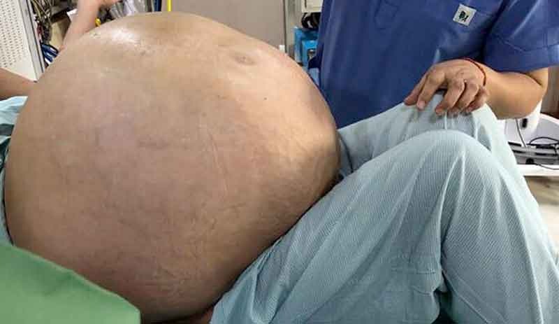 Hindistan'da bir kadının yumurtalığından 54 kilogram tümör çıkarıldı