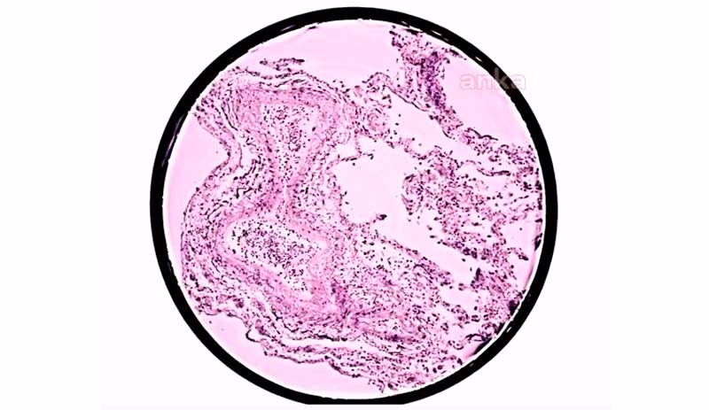 Coronavirus'ün akciğerdeki yayılımı ilk kez üç boyutlu modellendi