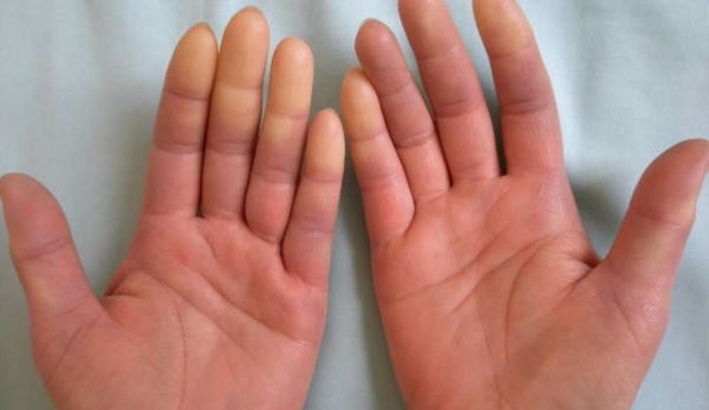 Romatoloji uzmanından uyarı: Raynaud Sendromu enfeksiyona neden olabilir