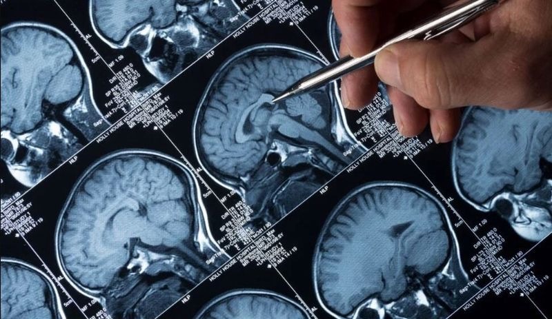 Nöroloji uzmanı profesör: Pandemi, yeni epilepsi vakalarını ortaya çıkarabilir