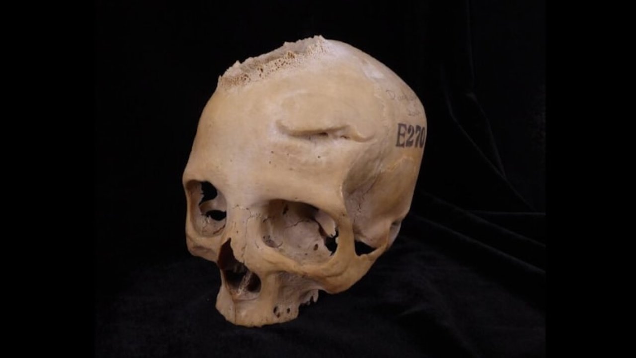 Antik Mısır'da kanser tedavisi: 4 bin yıllık kafatası incelendi