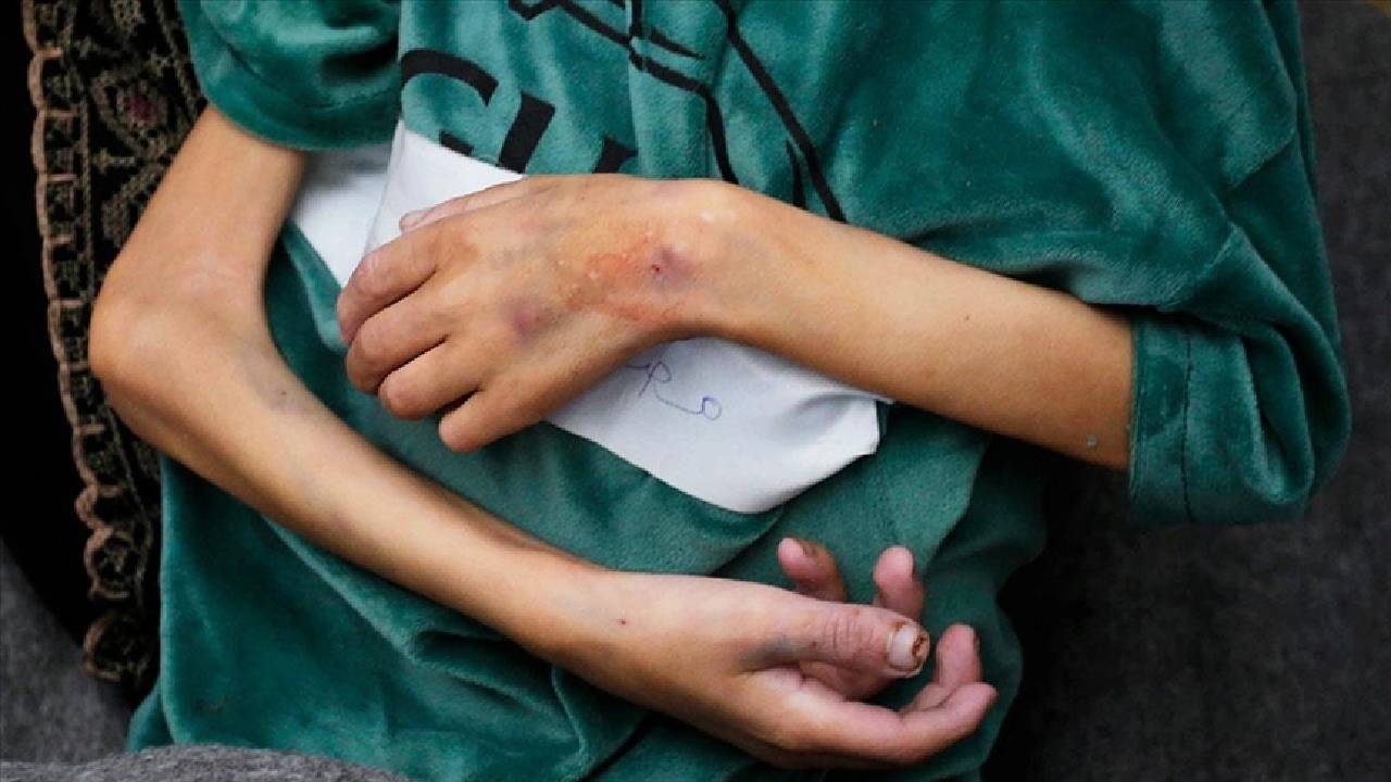 Gazze'nin kuzeyindeki hastaneye yetersiz beslenme nedeniyle getirilen çocuklar: Bir hafta içinde dördü öldü