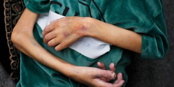 Gazze'nin kuzeyindeki hastaneye yetersiz beslenme nedeniyle getirilen çocuklar: Bir hafta içinde dördü öldü